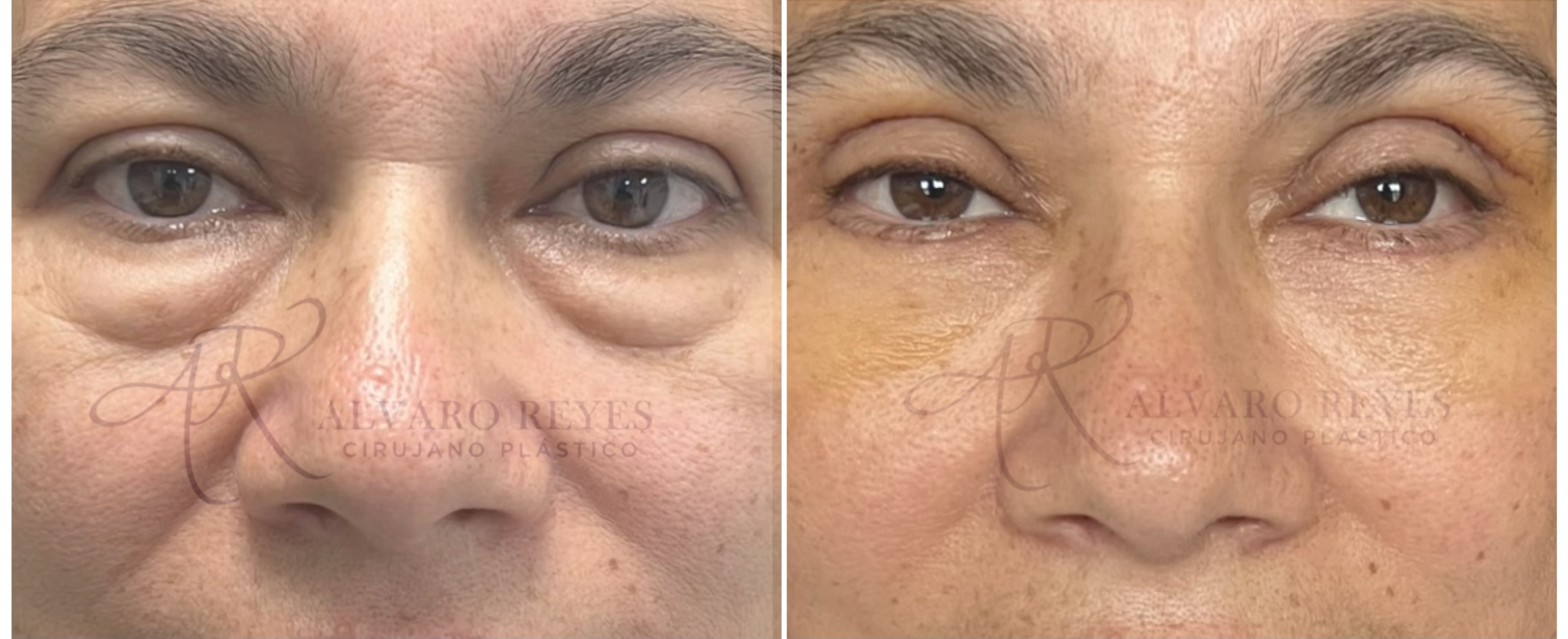 Blefaroplastia