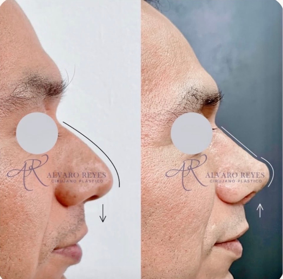 Rinoplastia