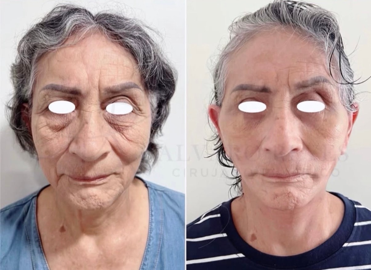 Lifting Facial